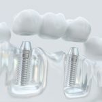 implant_bridge.jpg